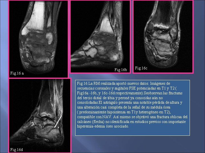 Fig. 16 a Fig. 16 b Fig. 16 c Fig. 16. La RM realizada