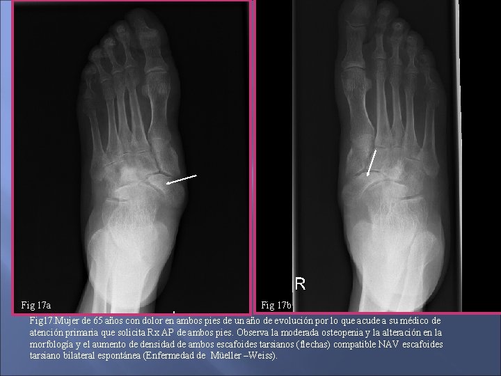 Fig 17 a Fig 17 b Fig 17. Mujer de 65 años con dolor