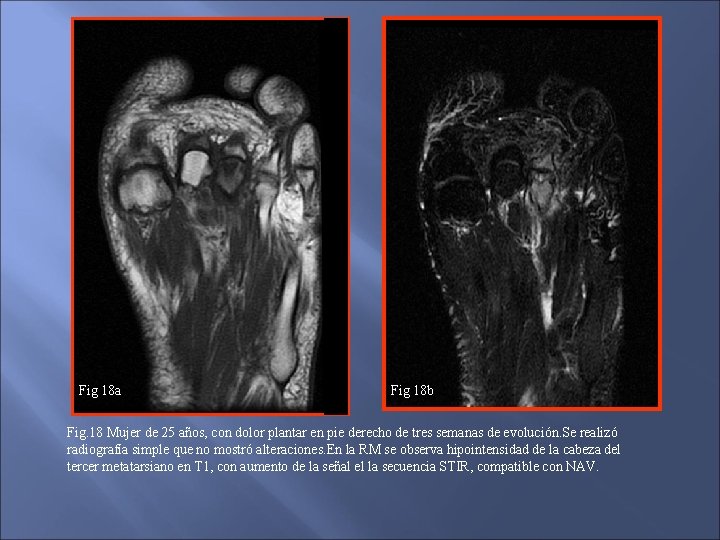 Fig 18 a Fig 18 b Fig. 18 Mujer de 25 años, con dolor