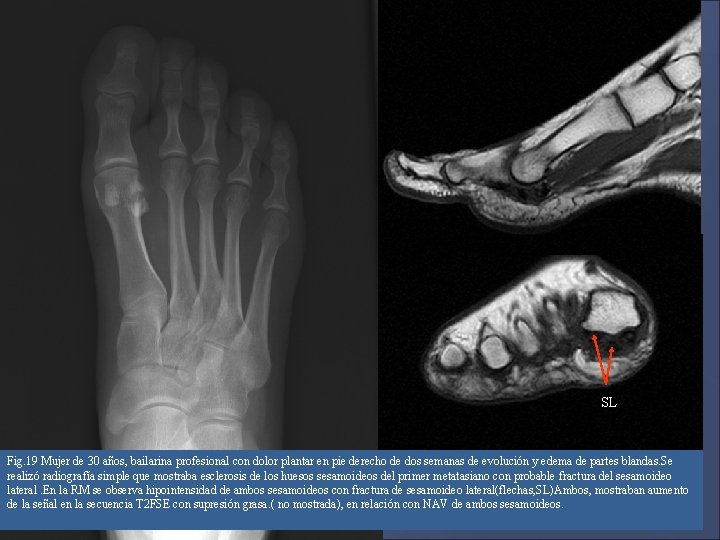SL Fig. 19 Mujer de 30 años, bailarina profesional con dolor plantar en pie