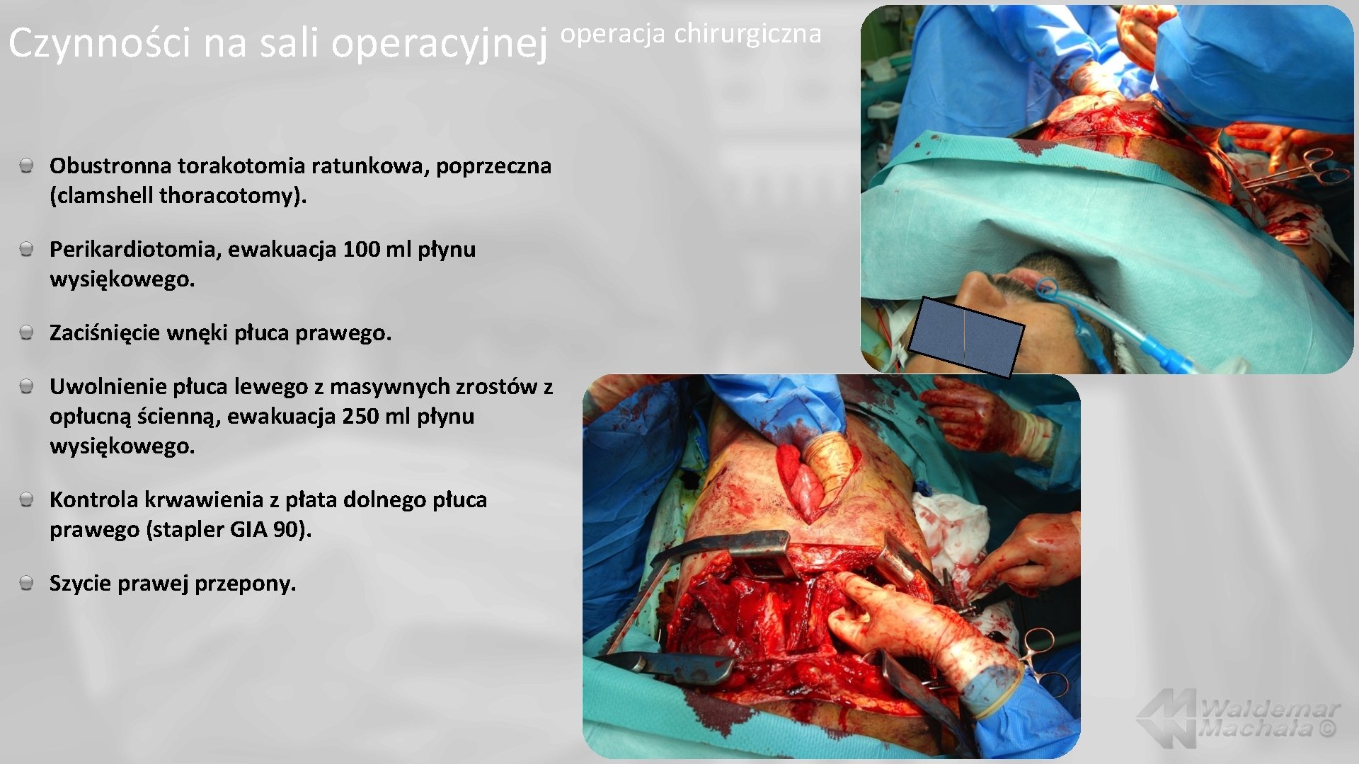 Czynności na sali operacyjnej Obustronna torakotomia ratunkowa, poprzeczna (clamshell thoracotomy). Perikardiotomia, ewakuacja 100 ml