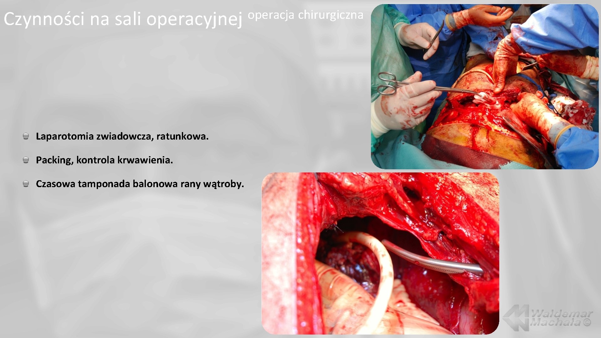Czynności na sali operacyjnej Laparotomia zwiadowcza, ratunkowa. Packing, kontrola krwawienia. Czasowa tamponada balonowa rany