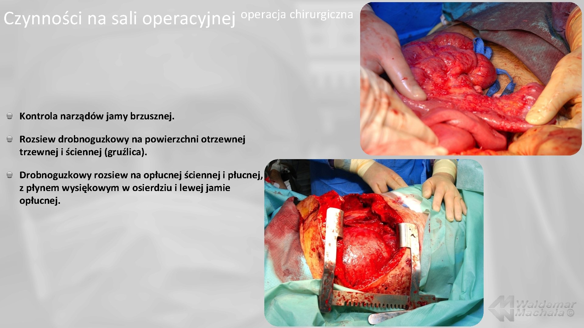 Czynności na sali operacyjnej operacja chirurgiczna Kontrola narządów jamy brzusznej. Rozsiew drobnoguzkowy na powierzchni