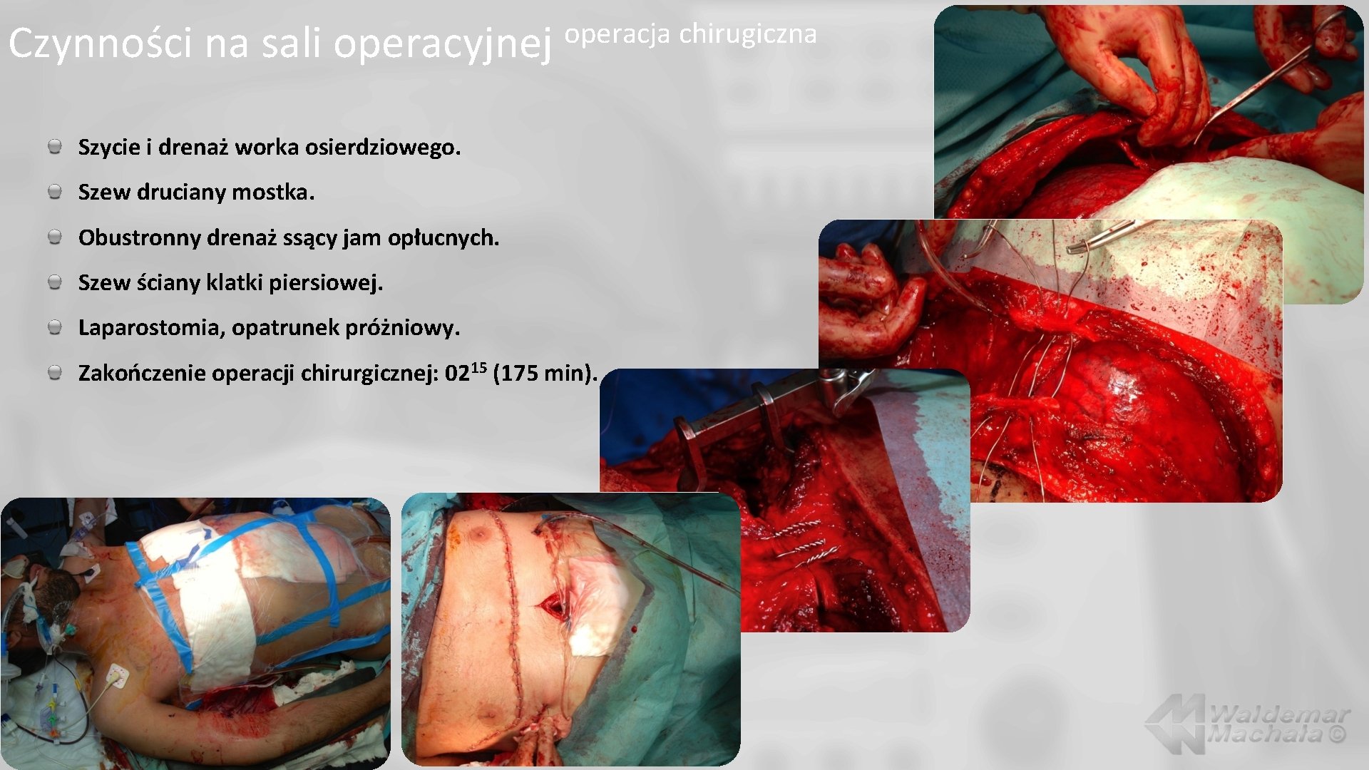 Czynności na sali operacyjnej operacja chirugiczna Szycie i drenaż worka osierdziowego. Szew druciany mostka.