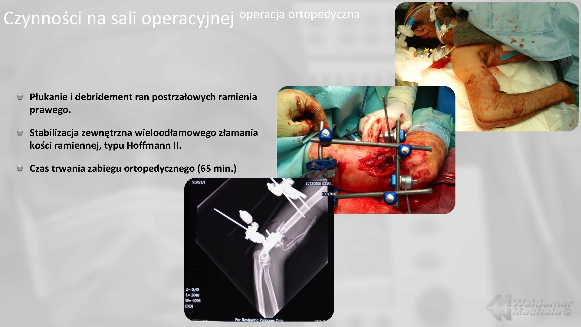 Czynności na sali operacyjnej operacja ortopedyczna Płukanie i debridement ran postrzałowych ramienia prawego. Stabilizacja