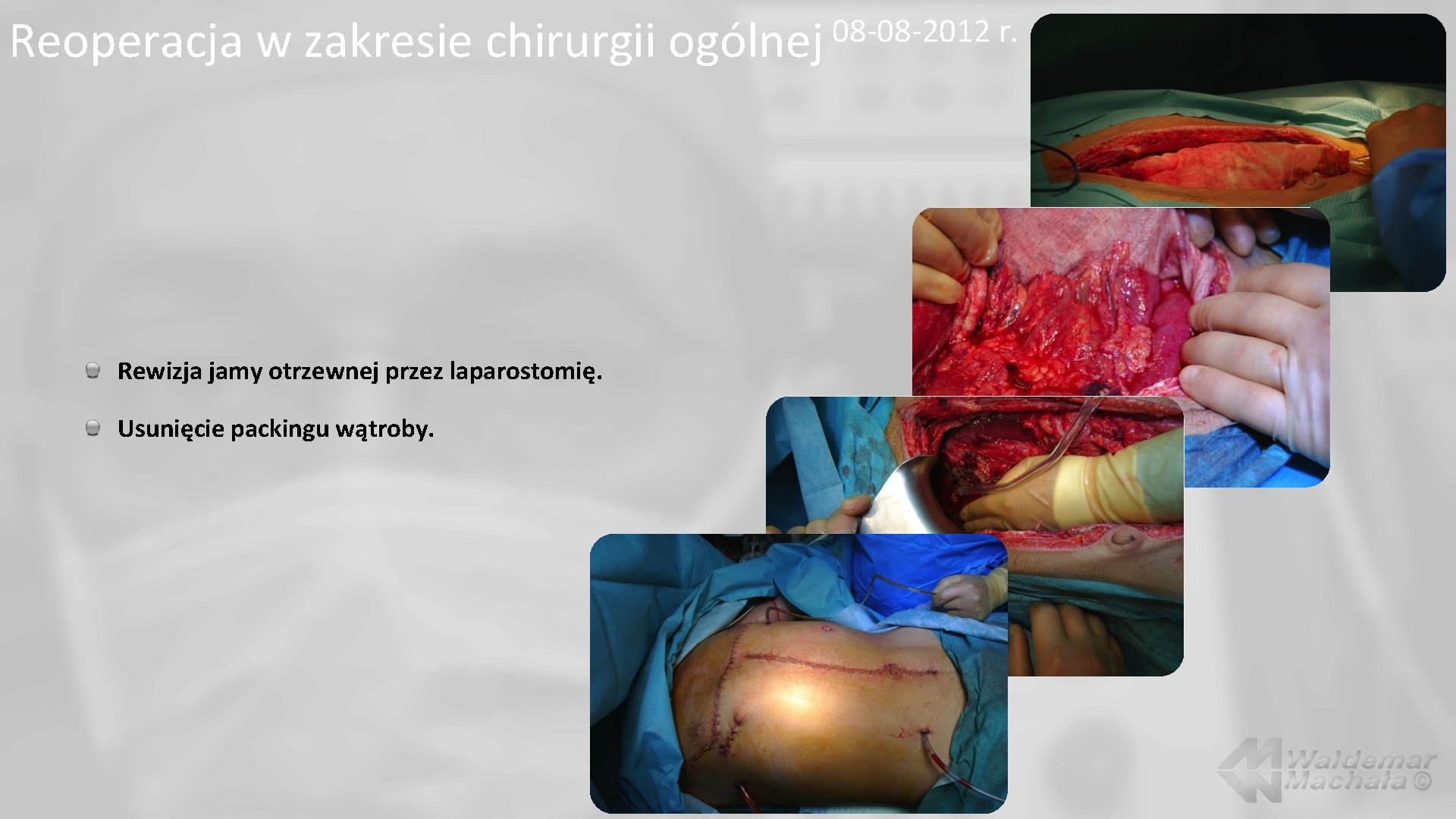 Reoperacja w zakresie chirurgii Rewizja jamy otrzewnej przez laparostomię. Usunięcie packingu wątroby. 08 -08