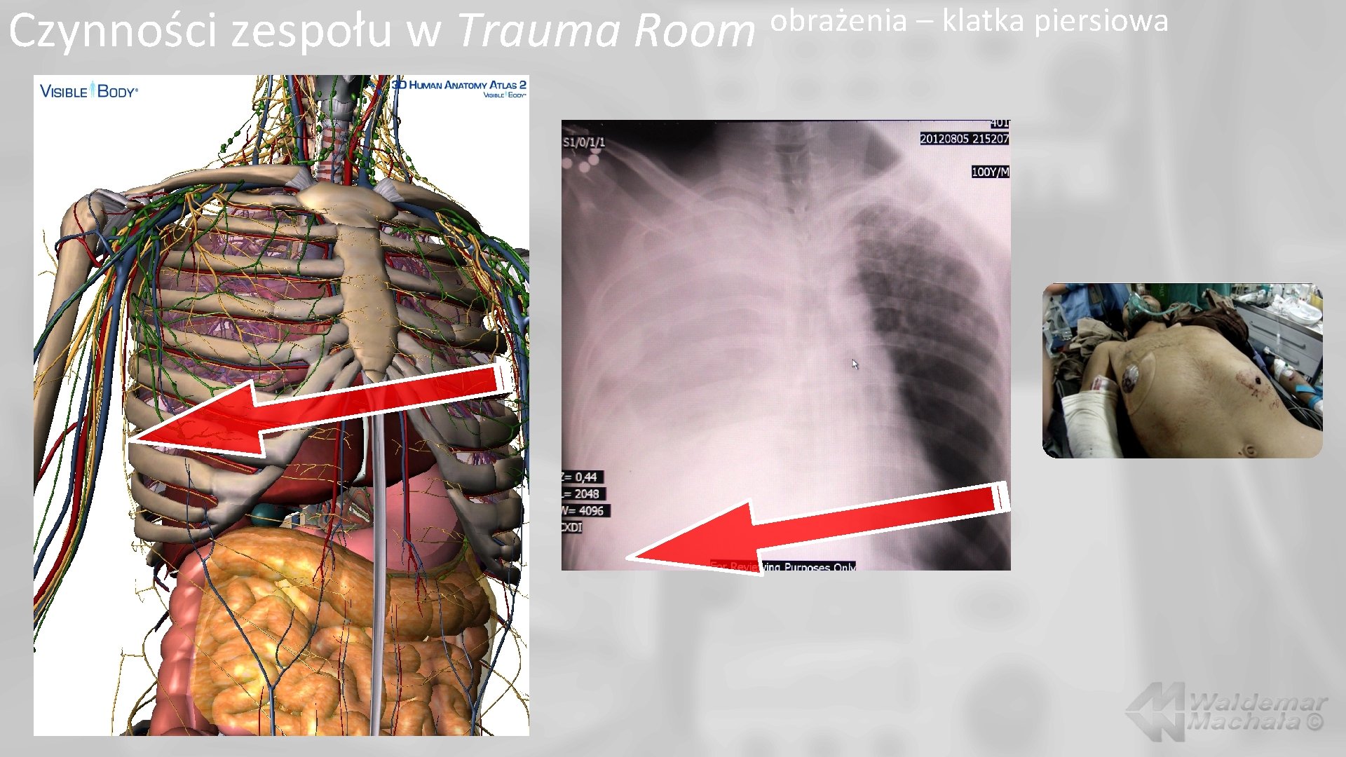 Czynności zespołu w Trauma Room obrażenia – klatka piersiowa 
