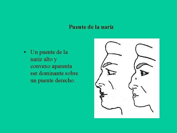 Puente de la nariz • Un puente de la nariz alto y convexo aparenta