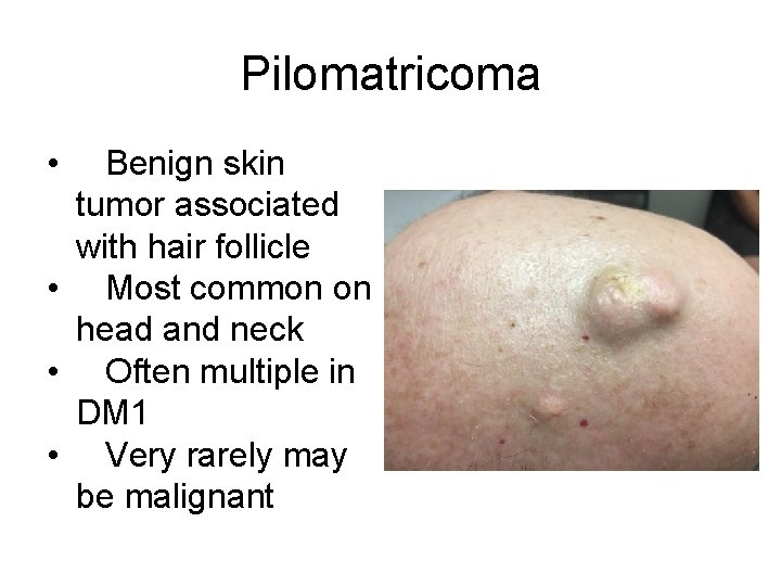 Pilomatricoma • Benign skin tumor associated with hair follicle • Most common on head