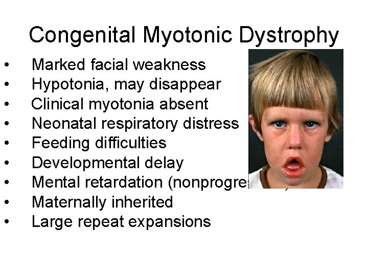 Congenital Myotonic Dystrophy • • • Marked facial weakness Hypotonia, may disappear Clinical myotonia