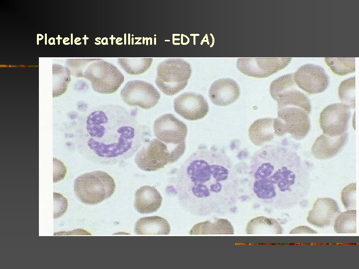 Platelet satellizmi -EDTA) 