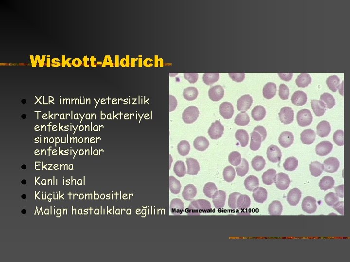 Wiskott-Aldrich l l l XLR immün yetersizlik Tekrarlayan bakteriyel enfeksiyonlar sinopulmoner enfeksiyonlar Ekzema Kanlı
