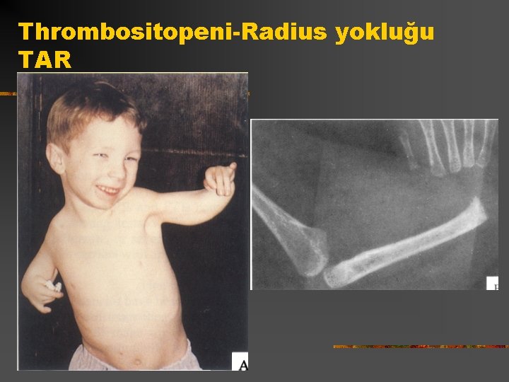Thrombositopeni-Radius yokluğu TAR 