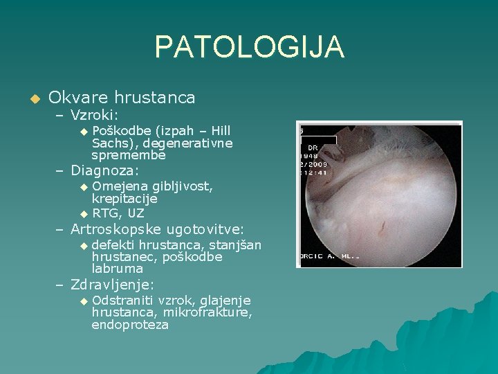 PATOLOGIJA u Okvare hrustanca – Vzroki: u Poškodbe (izpah – Hill Sachs), degenerativne spremembe