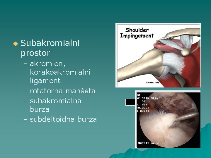 u Subakromialni prostor – akromion, korakoakromialni ligament – rotatorna manšeta – subakromialna burza –