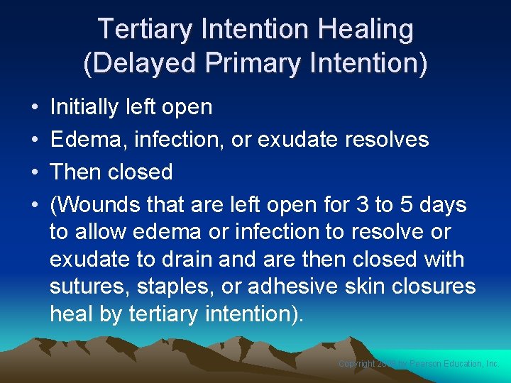 Tertiary Intention Healing (Delayed Primary Intention) • • Initially left open Edema, infection, or