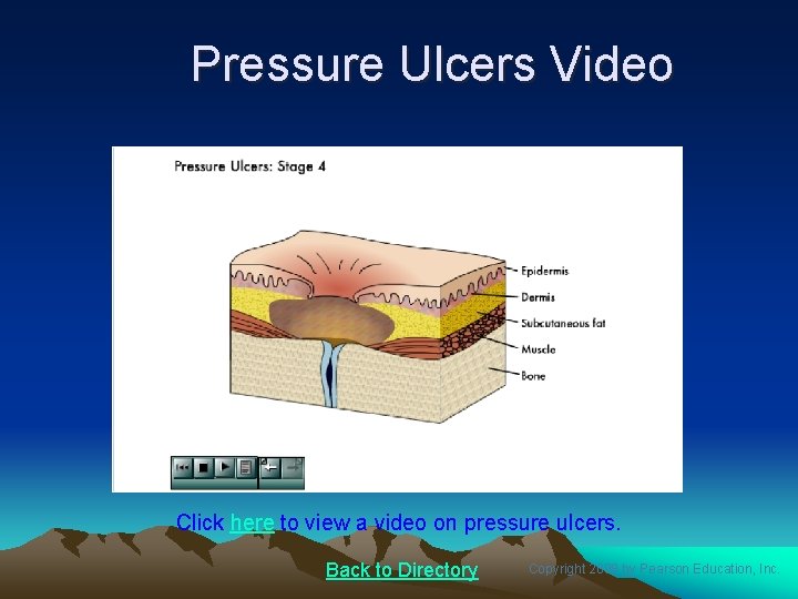 Pressure Ulcers Video Click here to view a video on pressure ulcers. Back to