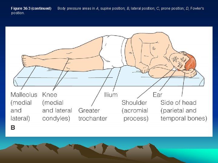 Figure 36 -3 (continued) position. Body pressure areas in A, supine position; B, lateral