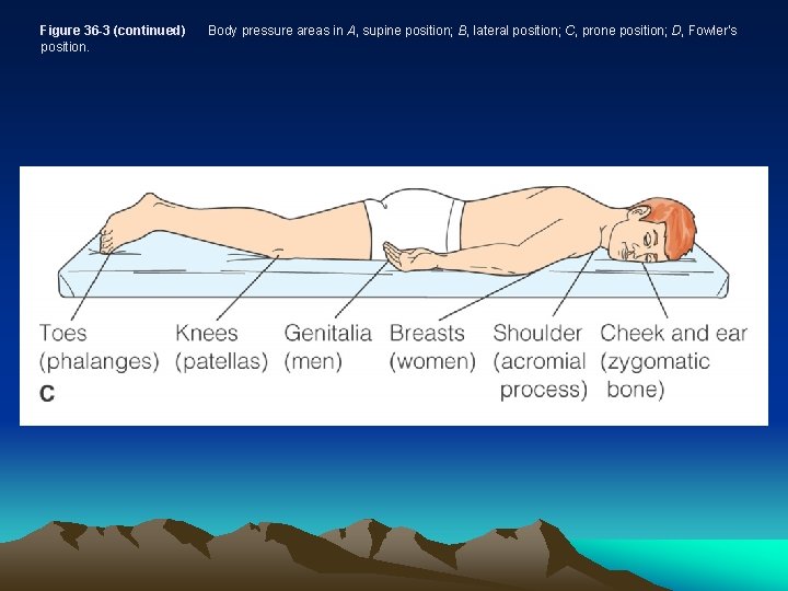 Figure 36 -3 (continued) position. Body pressure areas in A, supine position; B, lateral