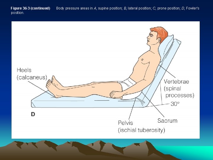 Figure 36 -3 (continued) position. Body pressure areas in A, supine position; B, lateral