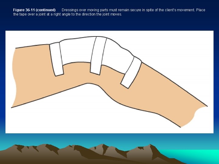 Figure 36 -11 (continued) Dressings over moving parts must remain secure in spite of