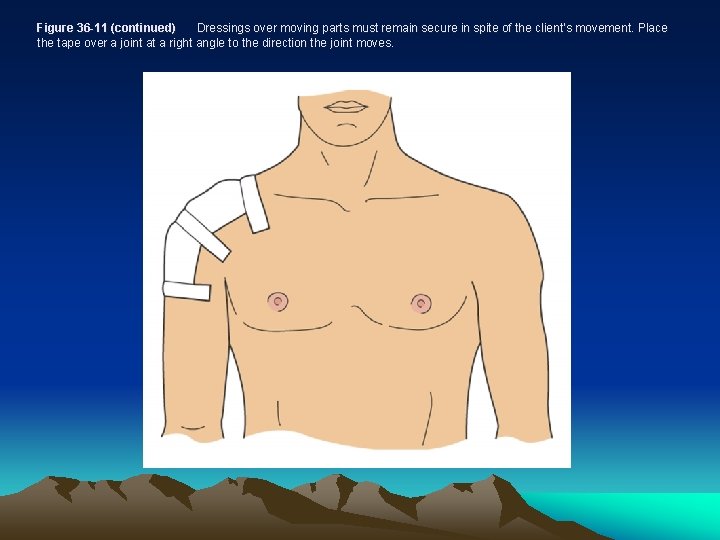 Figure 36 -11 (continued) Dressings over moving parts must remain secure in spite of