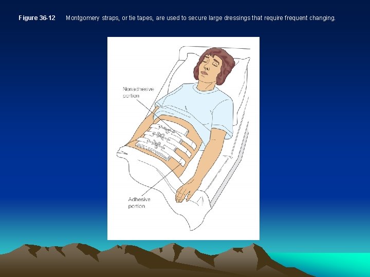 Figure 36 -12 Montgomery straps, or tie tapes, are used to secure large dressings