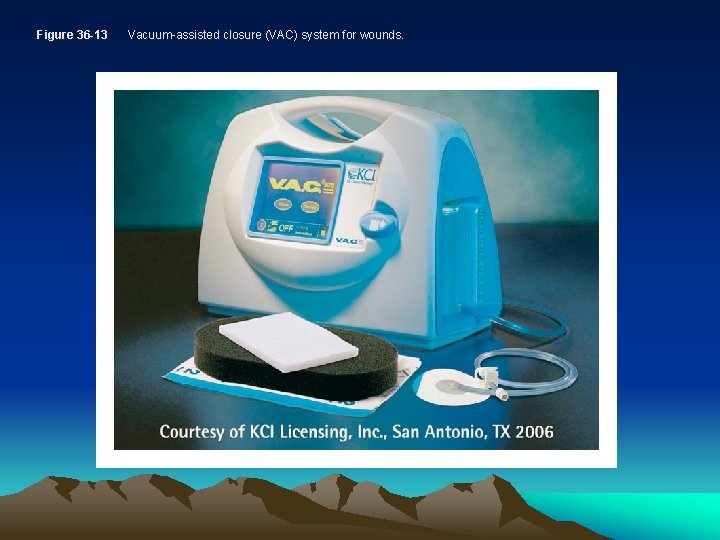 Figure 36 -13 Vacuum-assisted closure (VAC) system for wounds. 