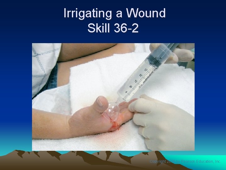 Irrigating a Wound Skill 36 -2 Copyright 2008 by Pearson Education, Inc. 