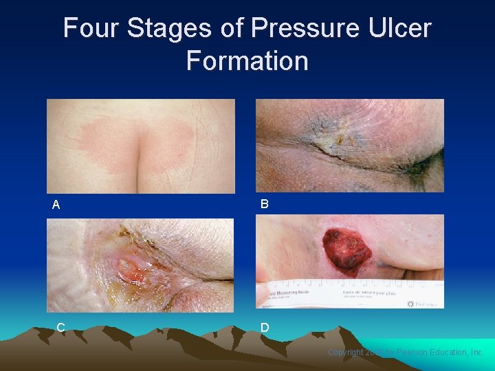Four Stages of Pressure Ulcer Formation A C B D Copyright 2008 by Pearson