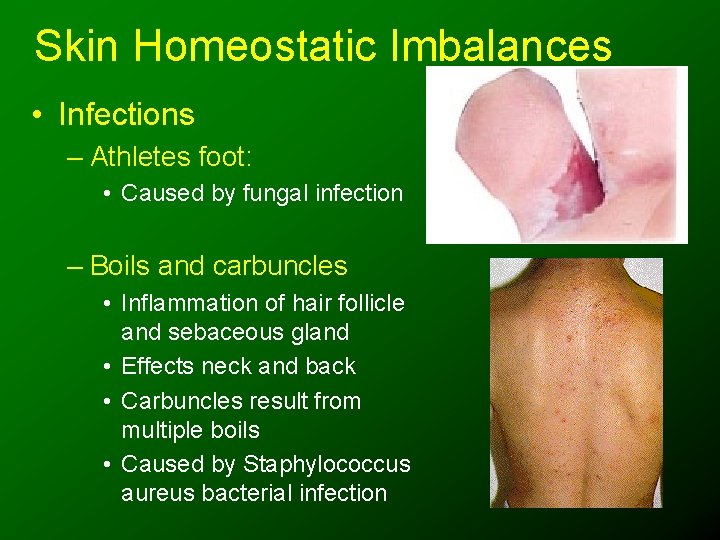 Skin Homeostatic Imbalances • Infections – Athletes foot: • Caused by fungal infection –