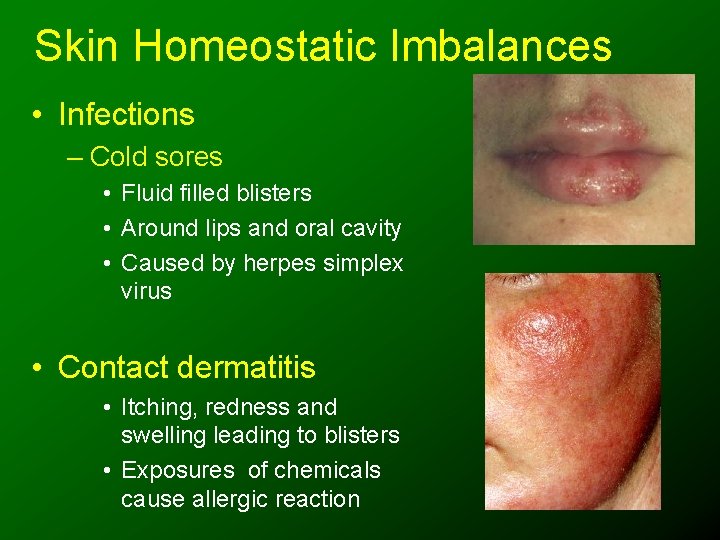 Skin Homeostatic Imbalances • Infections – Cold sores • Fluid filled blisters • Around