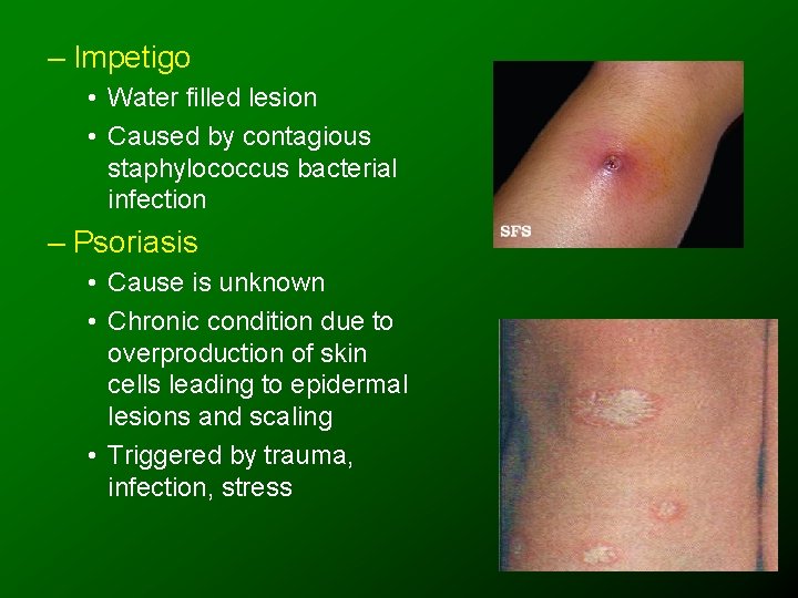 – Impetigo • Water filled lesion • Caused by contagious staphylococcus bacterial infection –