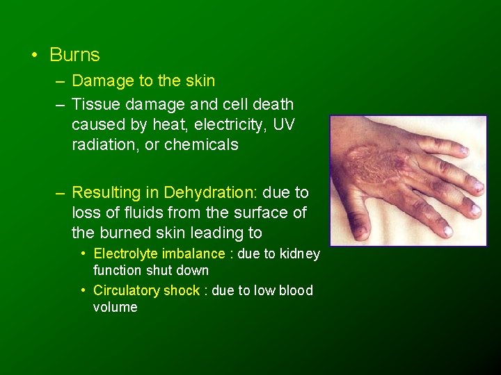  • Burns – Damage to the skin – Tissue damage and cell death