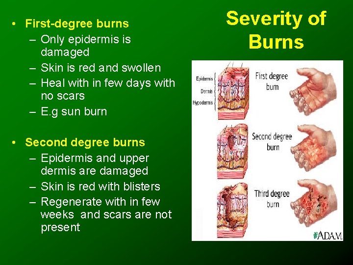  • First-degree burns – Only epidermis is damaged – Skin is red and
