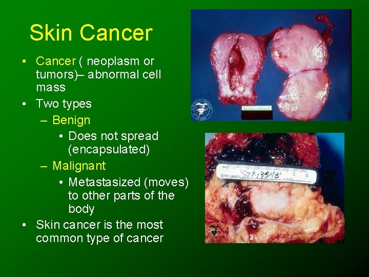 Skin Cancer • Cancer ( neoplasm or tumors)– abnormal cell mass • Two types