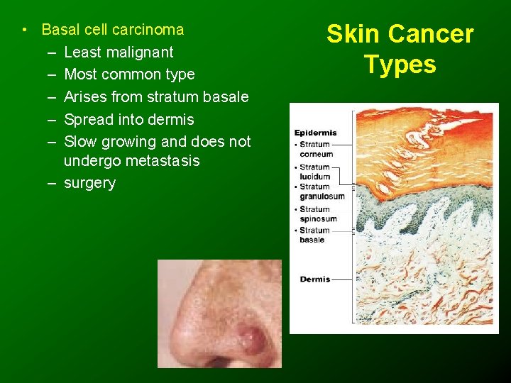  • Basal cell carcinoma – Least malignant – Most common type – Arises