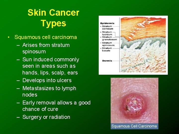 Skin Cancer Types • Squamous cell carcinoma – Arises from stratum spinosum – Sun