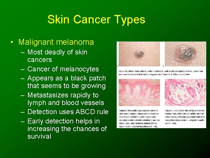 Skin Cancer Types • Malignant melanoma – Most deadly of skin cancers – Cancer