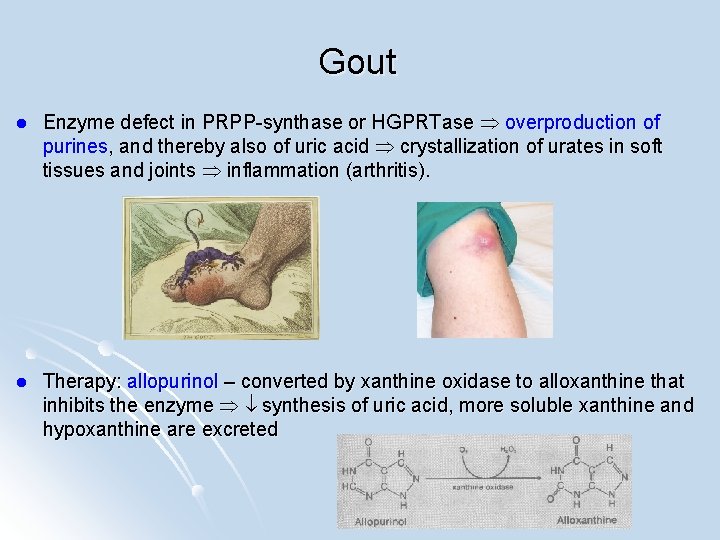 Gout l Enzyme defect in PRPP-synthase or HGPRTase overproduction of purines, and thereby also