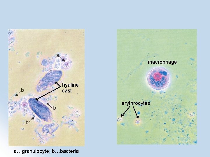 macrophage hyaline cast erythrocytes a…granulocyte; b…bacteria 