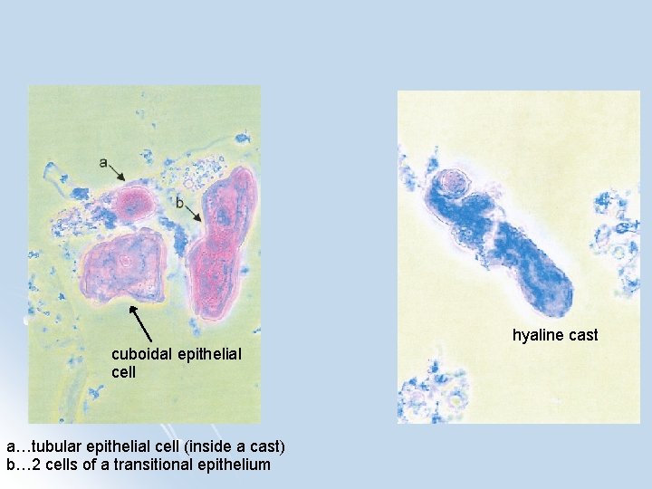 hyaline cast cuboidal epithelial cell a…tubular epithelial cell (inside a cast) b… 2 cells