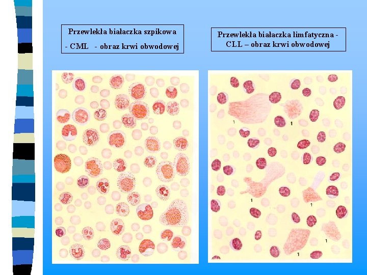Przewlekła białaczka szpikowa - CML - obraz krwi obwodowej Przewlekła białaczka limfatyczna - CLL