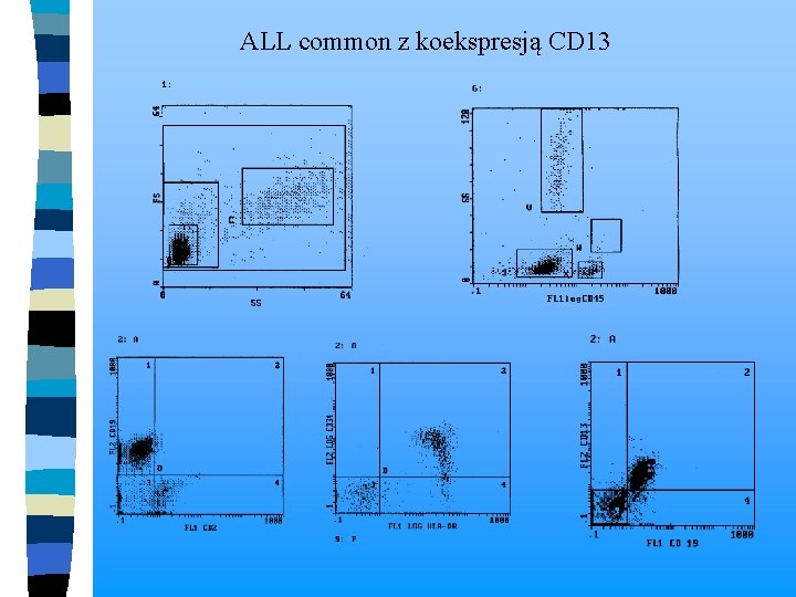  ALL common z koekspresją CD 13 
