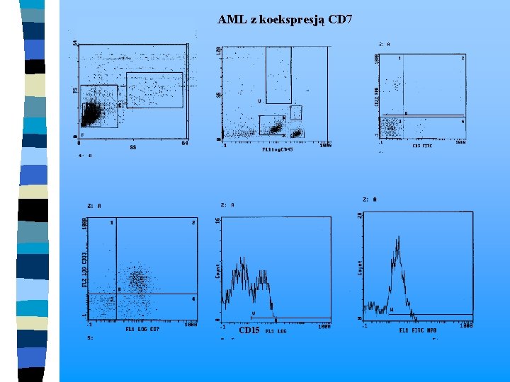 AML z koekspresją CD 7 CD 15 