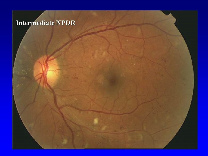 Intermediate NPDR 