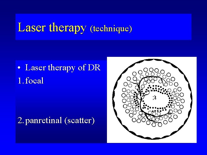 Laser therapy (technique) • Laser therapy of DR 1. focal 2. panretinal (scatter) 