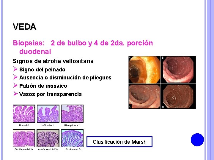 VEDA Biopsias: 2 de bulbo y 4 de 2 da. porción duodenal Signos de