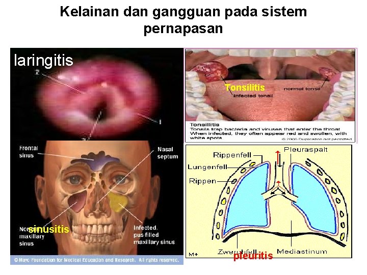 Kelainan dan gangguan pada sistem pernapasan laringitis Tonsilitis sinusitis pleuritis 