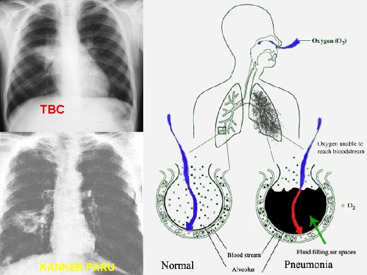 TBC KANKER PARU 